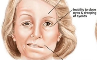 MS是什么病_MS能治好吗