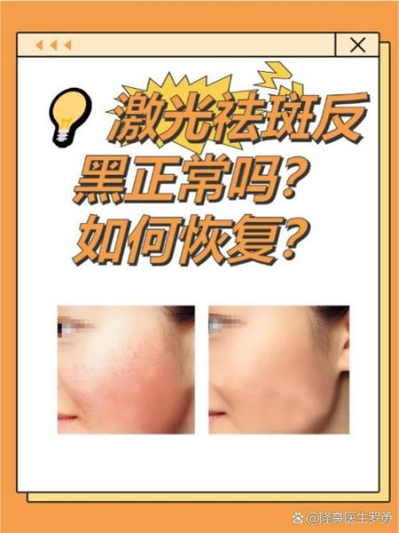 祛斑最有效的方法是什么_祛斑后会不会反弹-第2张图片-俊逸知识馆 祛斑最有效的方法是什么_祛斑后会不会反弹-第2张图片-俊逸知识馆
