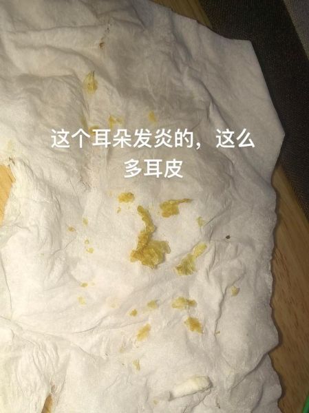 耳屎多了会怎么样_耳屎堵塞耳朵怎么办-第3张图片-俊逸知识馆 耳屎多了会怎么样_耳屎堵塞耳朵怎么办-第3张图片-俊逸知识馆