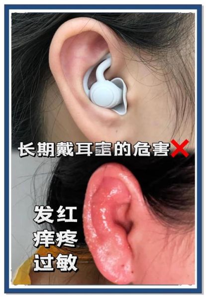 耳塞戴久了会怎么样_长期戴耳塞的危害-第1张图片-俊逸知识馆
