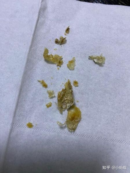 吃了耳屎会怎么样_耳屎有毒吗-第1张图片-俊逸知识馆